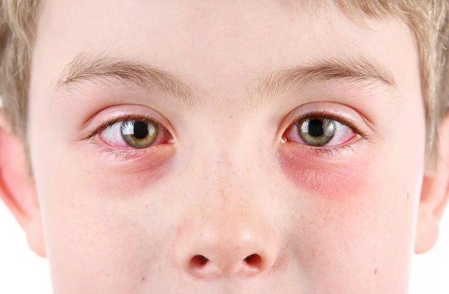 Early stage pink eye symptoms